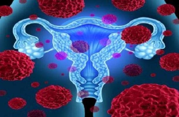 آنچه زنان باید در مورد سرطان تخمدان بدانند